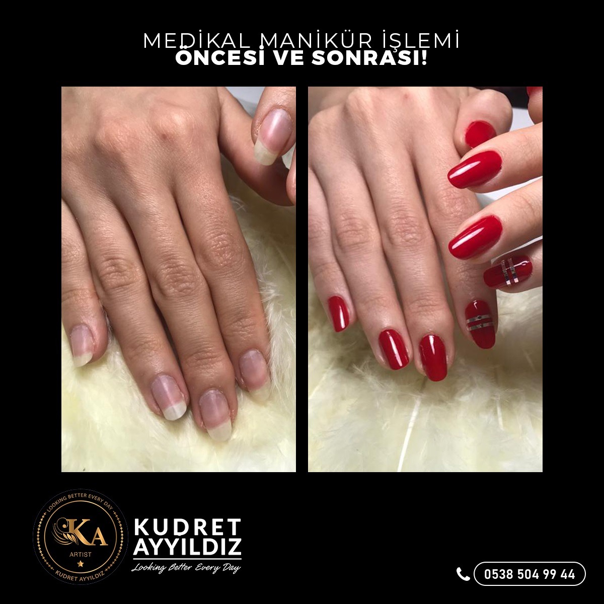 Medikal manikür işlemi öncesi ve sonrası — Kudret Ayyıldız Beauty Center